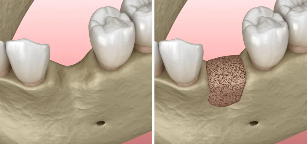 greffes osseuses parodontologie chirurgicale greffes osseuses parodontologie chirurgicale Traitements Chirurgien-dentiste Alby-sur-Chéran - Dr Paulin CARTIER
