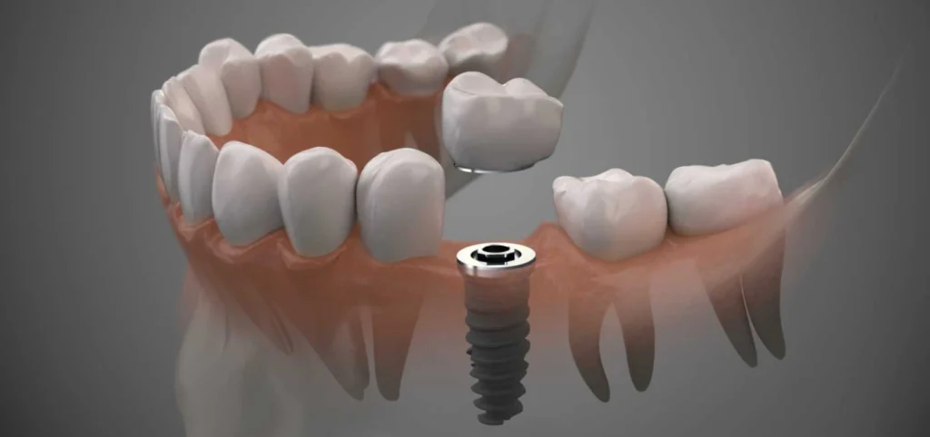 implants dentaires implants dentaires Traitements Chirurgien-dentiste Alby-sur-Chéran - Dr Paulin CARTIER
