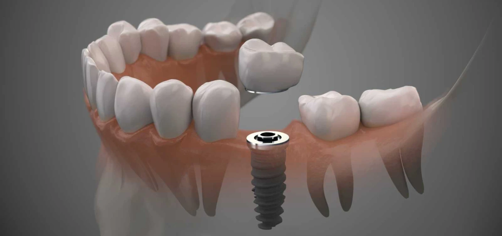 implants dentaires Implants dentaires Chirurgien-dentiste Alby-sur-Chéran - Dr Paulin CARTIER