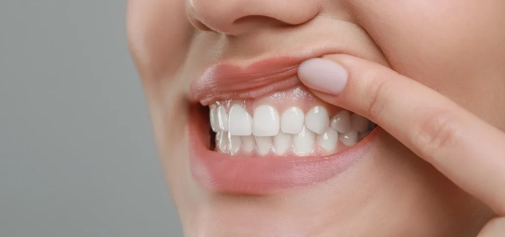 soins gencives soins gencives Traitements Chirurgien-dentiste Alby-sur-Chéran - Dr Paulin CARTIER