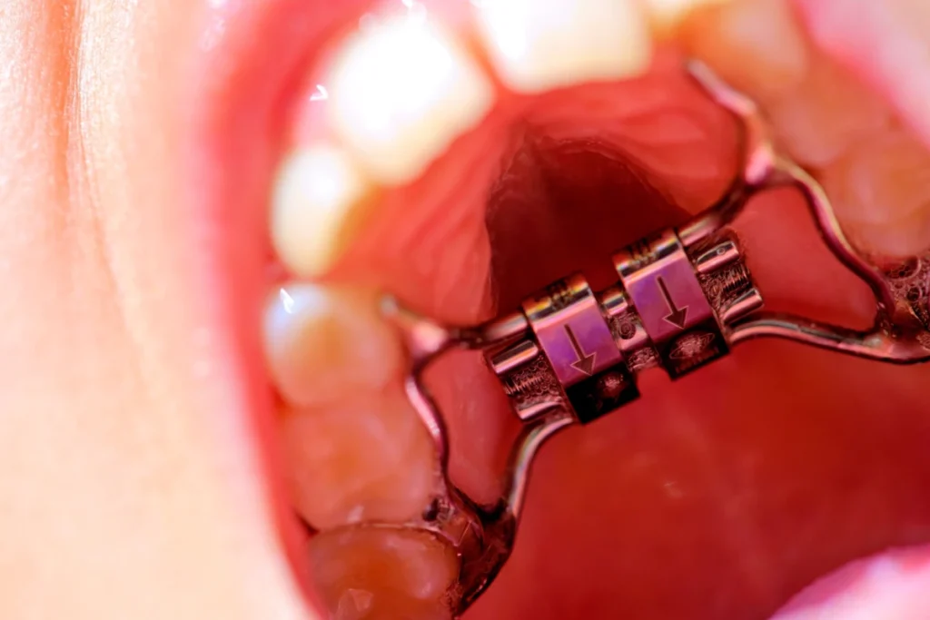 disjoncteur orthodontie enfant disjoncteur orthodontie enfant Orthodontie Chirurgien-dentiste Alby-sur-Chéran - Dr Paulin CARTIER