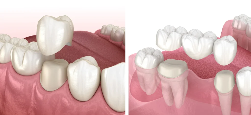 couronnes ponts bridge dentaire x Soins conservateurs Cabinet CDA | Chirurgiens-dentistes à Alby-sur-Chéran