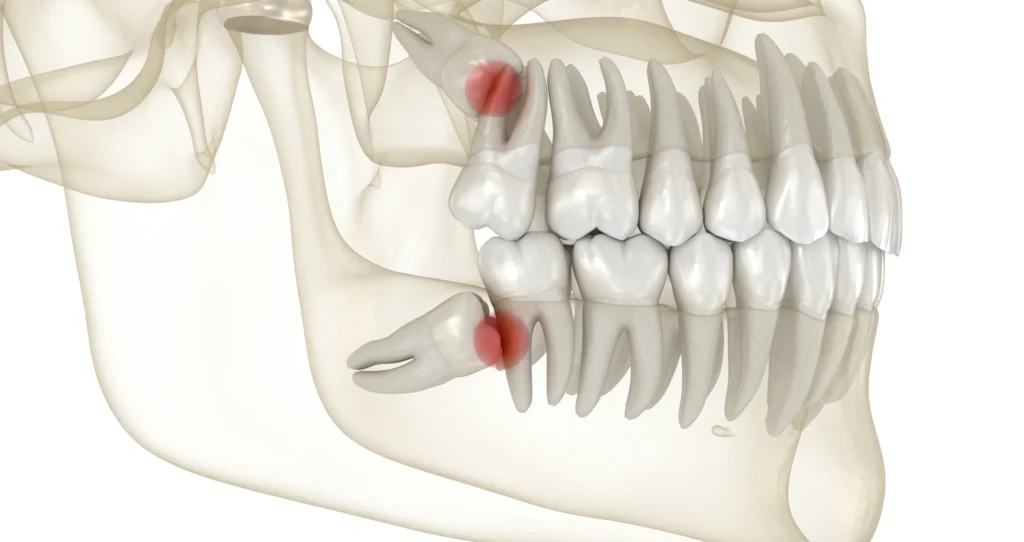 dents sagesse extraction dentiste alby sur cheran dents sagesse extraction dentiste alby sur cheran Conseils post-extraction Chirurgien-dentiste Alby-sur-Chéran - Dr Paulin CARTIER